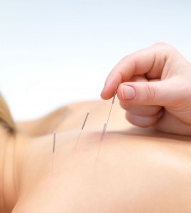 acupuncture